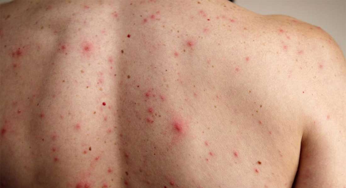 Mexico-se-disparan ¡Alerta sanitaria! Casos de sarampión en México se disparan 137% en 2026