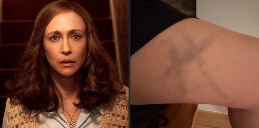 Moretones-en-la-actriz-del-conjuro La actriz Vera Farmiga volvió a vivir algo extraño en el set de El Conjuro